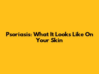 Psoriasis: What It Looks Like On Your Skin